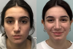 RHINOPLASTY – CASE 3