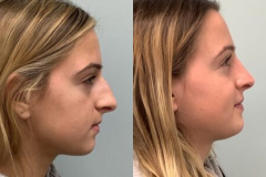 RHINOPLASTY – CASE 10