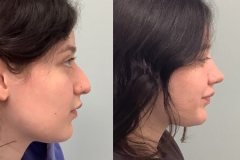 RHINOPLASTY – CASE 8