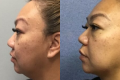 RHINOPLASTY – CASE 7