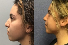 RHINOPLASTY – CASE 6