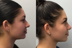 RHINOPLASTY – CASE 1