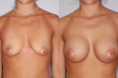 BREAST-AUGMENTATION-CASE-1