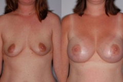 BREAST-AUGMENTATION-CASE-10