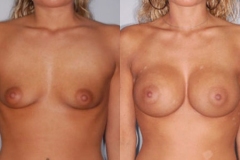 BREAST-AUGMENTATION-CASE-11