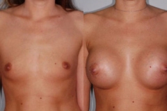 BREAST-AUGMENTATION-CASE-12