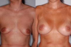 BREAST-AUGMENTATION-CASE-13