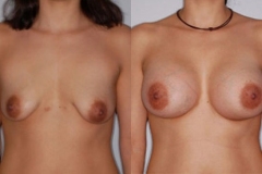 BREAST-AUGMENTATION-CASE-14