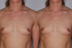 BREAST-AUGMENTATION-CASE-15