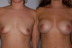 BREAST-AUGMENTATION-CASE-16