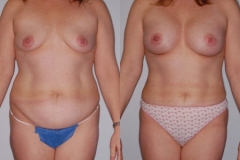 BREAST-AUGMENTATION-CASE-17