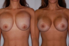 BREAST-AUGMENTATION-CASE-18