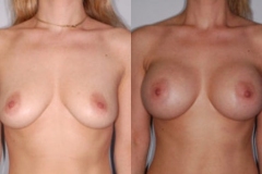 BREAST-AUGMENTATION-CASE-19