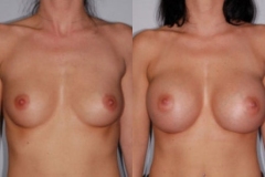 BREAST-AUGMENTATION-CASE-20