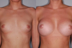 BREAST-AUGMENTATION-CASE-23