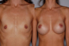 BREAST-AUGMENTATION-CASE-24