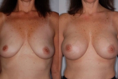 BREAST-AUGMENTATION-CASE-25