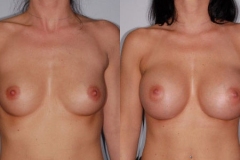 BREAST-AUGMENTATION-CASE-26