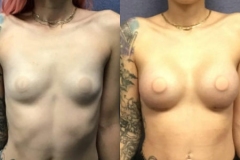 BREAST-AUGMENTATION-CASE-27