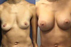 BREAST-AUGMENTATION-CASE-28