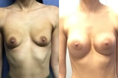 BREAST-AUGMENTATION-CASE-29