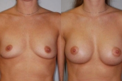 BREAST-AUGMENTATION-CASE-3