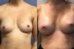 BREAST-AUGMENTATION-CASE-30