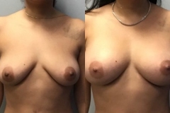 BREAST-AUGMENTATION-CASE-31