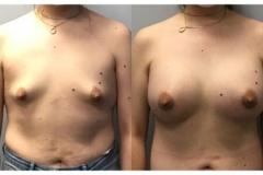 BREAST-AUGMENTATION-CASE-32