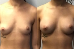 BREAST-AUGMENTATION-CASE-33