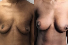 BREAST-AUGMENTATION-CASE-34