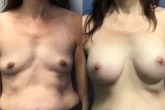 BREAST-AUGMENTATION-CASE-35