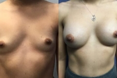 BREAST-AUGMENTATION-CASE-36