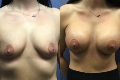 BREAST-AUGMENTATION-CASE-37