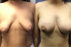 BREAST-AUGMENTATION-CASE-38