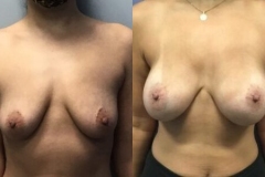 BREAST-AUGMENTATION-CASE-39