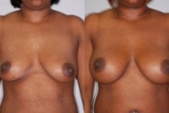 BREAST-AUGMENTATION-CASE-4