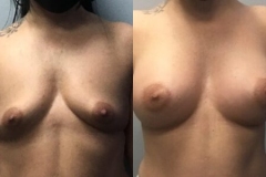 BREAST-AUGMENTATION-CASE-40