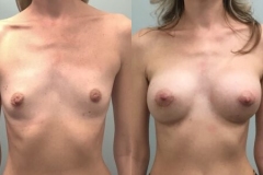 BREAST-AUGMENTATION-CASE-42