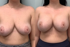 BREAST-AUGMENTATION-CASE-43