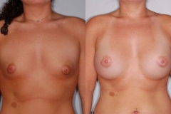 BREAST-AUGMENTATION-CASE-5