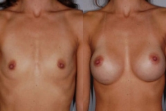 BREAST-AUGMENTATION-CASE-6