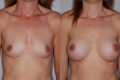 BREAST-AUGMENTATION-CASE-7