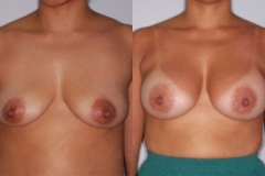 BREAST-AUGMENTATION-CASE-8