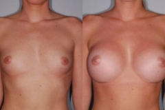 BREAST-AUGMENTATION-CASE-9