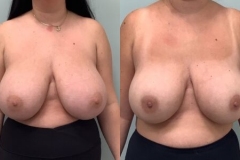 LIPOSUCTION – CASE 5