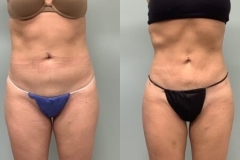 LIPOSUCTION – CASE 3