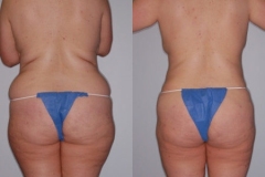 LIPOSUCTION – CASE 15