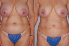 LIPOSUCTION – CASE 14