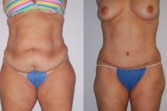 LIPOSUCTION – CASE 9